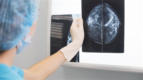 strålning efter bröstcancer operation